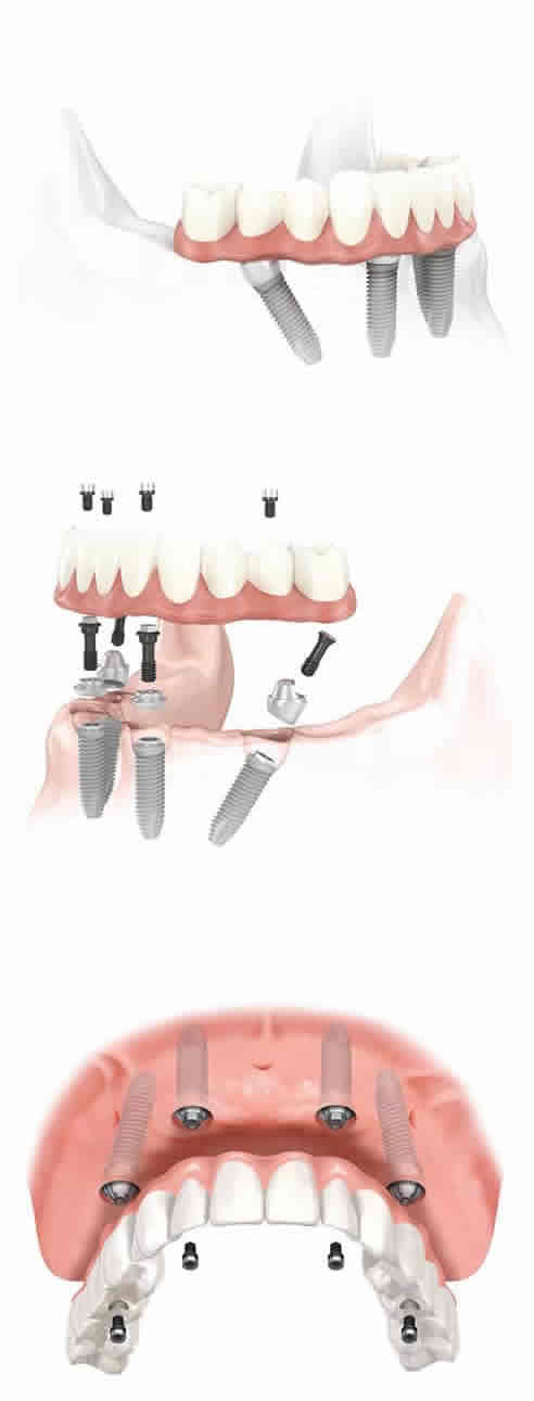 home-all-on-4-1 Dental implant procedure illustration steps