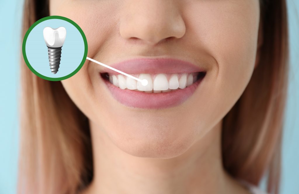 Discover the Power of Dental Implants at Smile Design LA, Los Angeles, CA