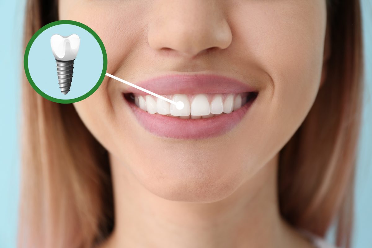 Woman with dental implant illustration on tooth.