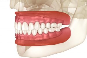 Removable,Prosthesis,,Artificial,Gum,And,Teeth.,Dental,3d,Illustration 3D illustration of human teeth and gums