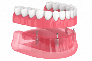 allon4 3D illustration of denture with dental implants